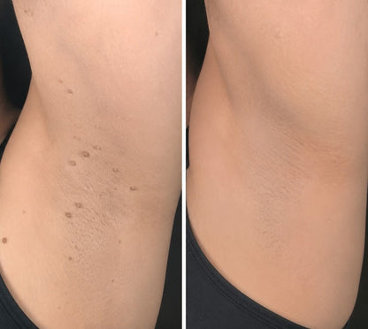 Wait — Your order is confirmed! 🎉Boost your routine with the new Hiskin® Wart Removal Patch, designed to pair with the Removal Pen for up to 200% enhanced results.👉 Add now & save 50%(Exclusive offer — only on this page)