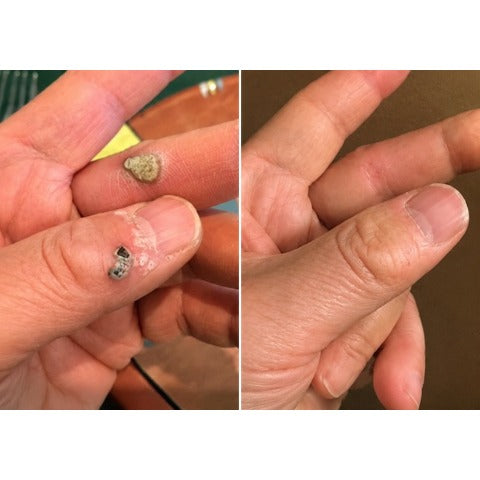 Wait — Your order is confirmed! 🎉Boost your routine with the new Hiskin® Wart Removal Patch, designed to pair with the Removal Pen for up to 200% enhanced results.👉 Add now & save 50%(Exclusive offer — only on this page)