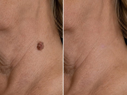 Wait — Your order is confirmed! 🎉Boost your routine with the new Hiskin® Wart Removal Patch, designed to pair with the Removal Pen for up to 200% enhanced results.👉 Add now & save 50%(Exclusive offer — only on this page)