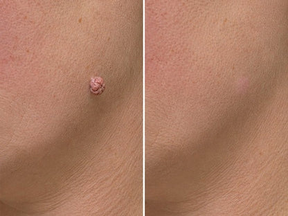 Wait — Your order is confirmed! 🎉Boost your routine with the new Hiskin® Wart Removal Patch, designed to pair with the Removal Pen for up to 200% enhanced results.👉 Add now & save 50%(Exclusive offer — only on this page)